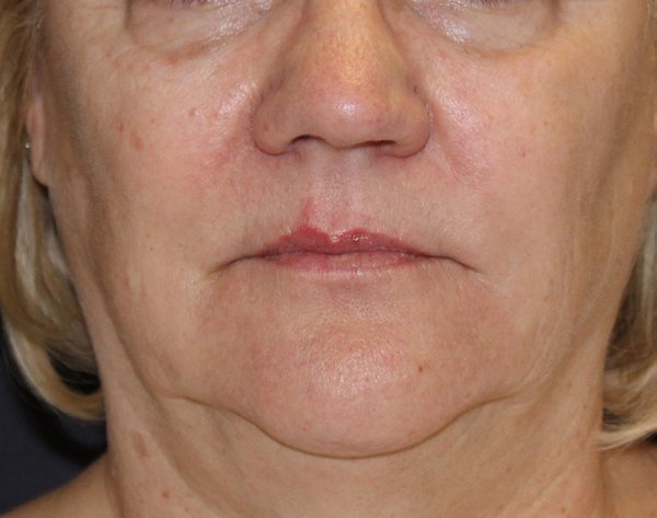 ultherapy before.jpg